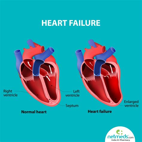 lv dysfunction symptoms|signs of left heart failure.